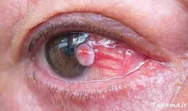 سرطان چشم