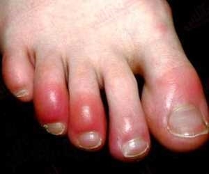 انگشت پای کوویدی